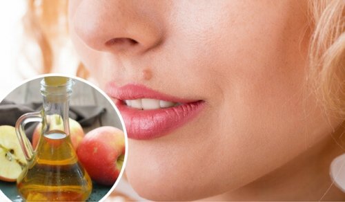 Naturlige måter å fjerne føflekker