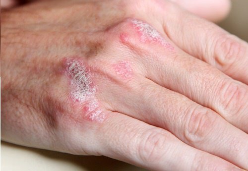 5 fakta om autoimmune sykdommer