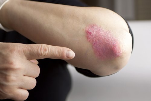 Psoriasis: Hva er det og hva er de ulike typene?