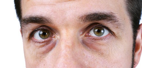 4 naturlige løsninger for mørke ringer under øynene