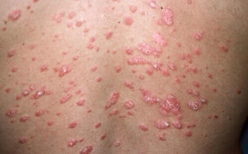 Psoriasis: Hva er det og hva er de ulike typene?