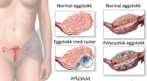 9 fakta om cyster på eggstokkene som enhver kvinne bør vite om