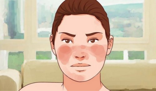 7 remedier for å kontrollere lupus