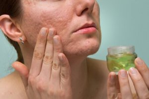 Effektiv, naturlig behandling for akne på haken din