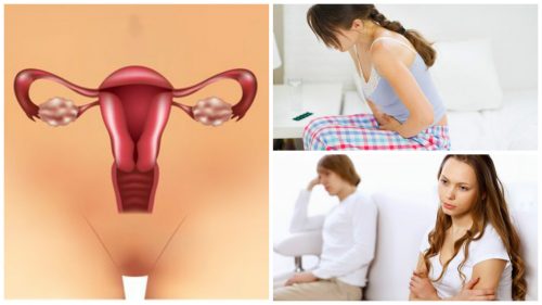 7 ting du bør vite om polycystisk ovariesyndrom
