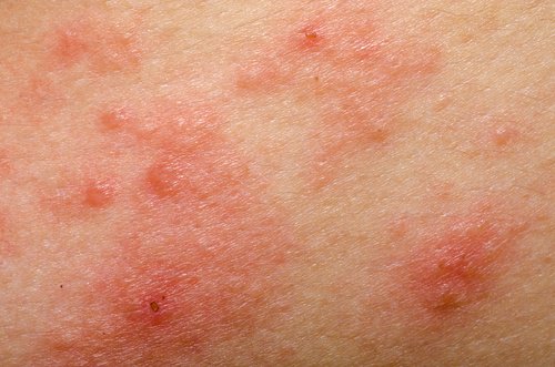 9 naturlige remedier mot rosacea