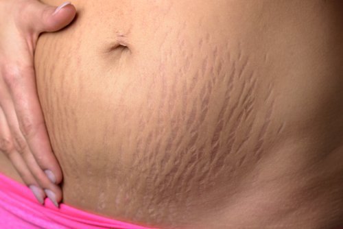 Fjern strekkmerker med disse 2 naturlige metodene Fjern strekkmerker med disse 2 naturlige metodene