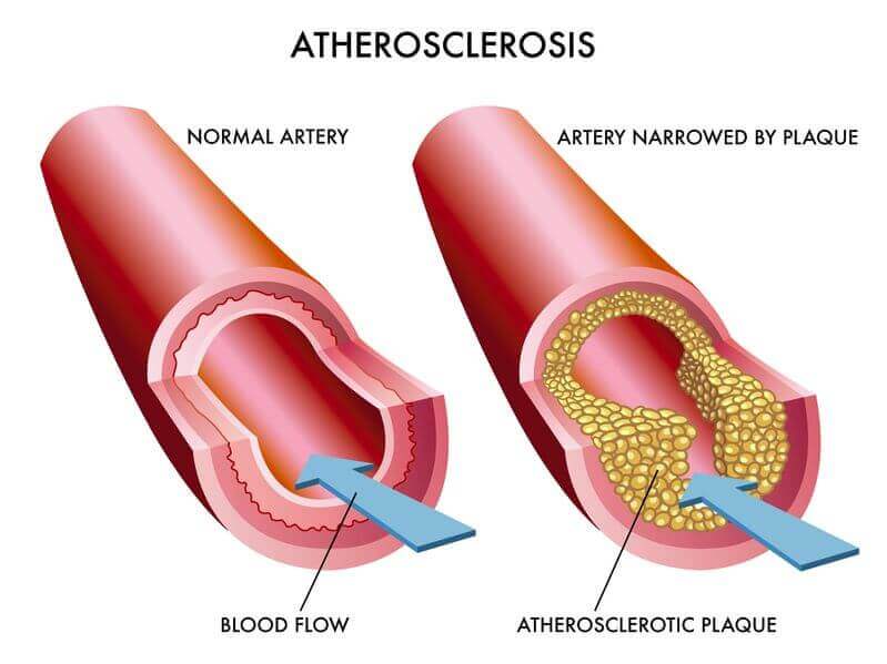 arterier