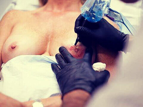 Artister gjenoppretter overlevende fra brystkreft sin femininitet