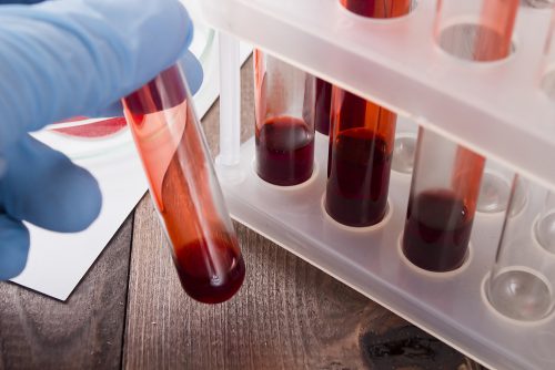 Gode ​​nyheter: Man kan nå oppdage kreft tidlig med blodprøver