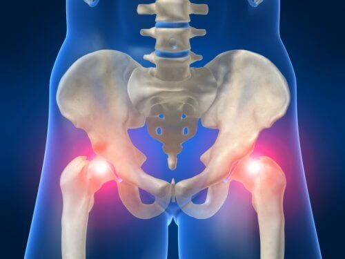 6 mulige årsaker til tilbakevennende hoftesmerter