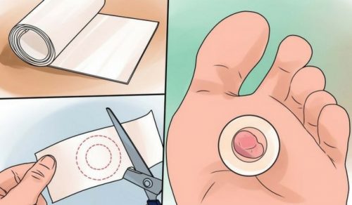 9 behandlinger for å helbrede vannblemmer