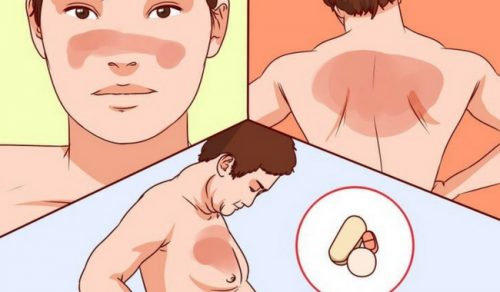 Alt du bør vite om lupus