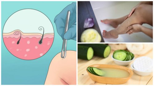 5 naturlige måter å bli kvitt inngrodde hår på