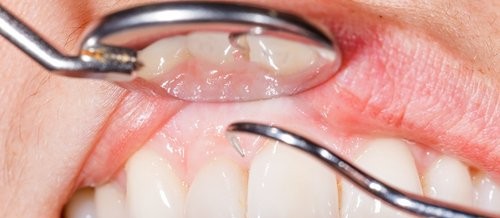 14 grunner til at tannkjøttet blør når du pusser tennene