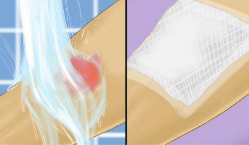 Førstehjelp for varmtvannsforbrenninger