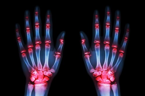 Utvikling i kontrollen av slitasjegikt