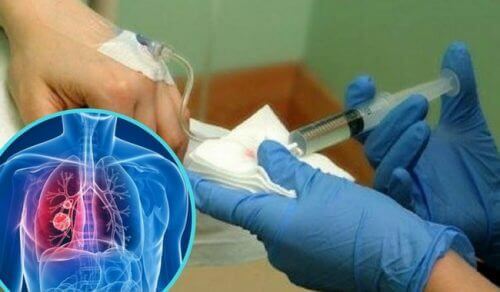 Forskere har oppdaget et stoff som lindrer bivirkninger ved bruk av kjemoterapi