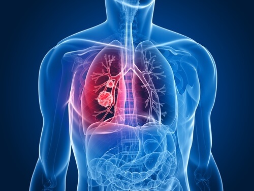 Lungekreft