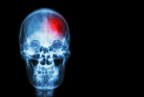 Kan du forhindre et hjerneslag?