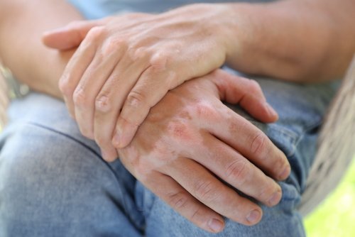 Hjemmelagde remedier for behandling av vitiligo