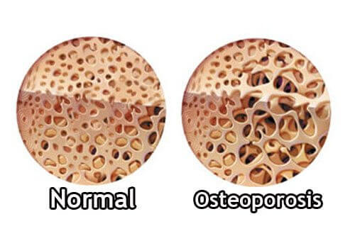 Hvordan kontrollere osteoporose i overgangsalderen