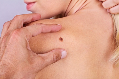 Symptomer og tegn på hudkreft du bør kjenne til