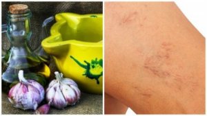 Naturlig behandling av åreknuter med olivenolje og hvitløk