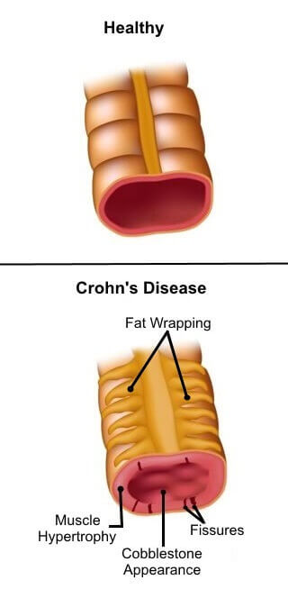 Crohns sykdom