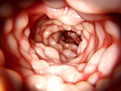 Behandling av Crohns sykdom - dette bør du vite