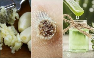 Bekjempe vorter med disse 5 naturlige remediene