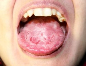 Hva er candidiasis?