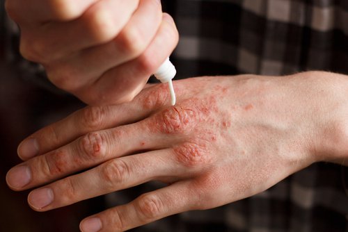 Behandling av psoriasis