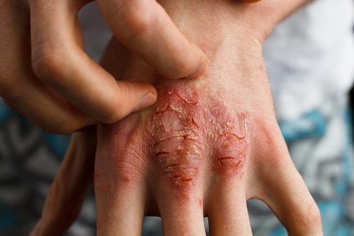 Behandling av psoriasis