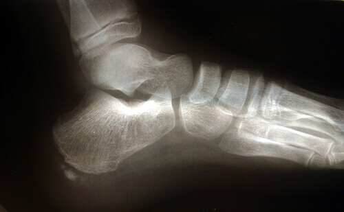 Røntgen av fot