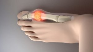 Finn ut hvordan du kan redusere urinsyre naturlig