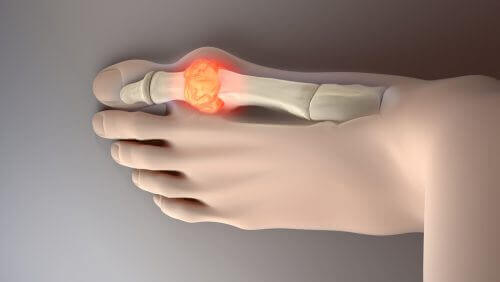 Senke nivåene av urinsyre - 8 ideelle matvarer