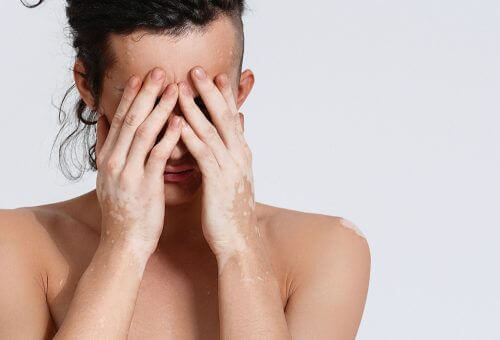 Person med vitiligo