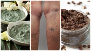 Bli kvitt åreknuter naturlig med disse hjemmelagde remediene