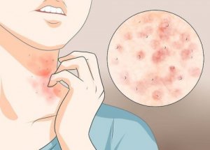 Tre enkle hjemmeremedier mot skabb