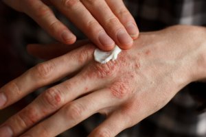Fem urtebaserte behandlinger mot psoriasis