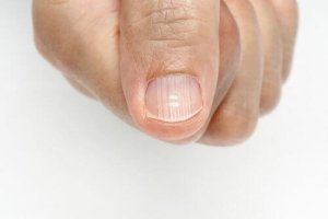 Slik kan du bli kvitt linjer på neglene