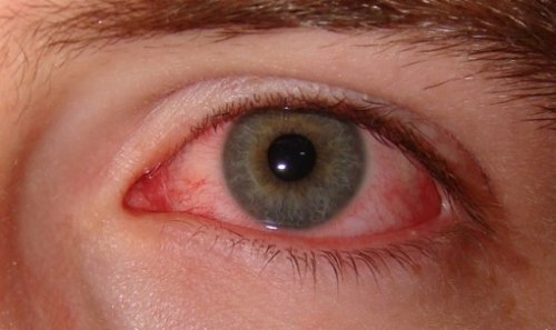 Tørt øye-syndrom