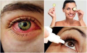 Tørt øye-syndrom: Hvordan bekjempe det naturlig