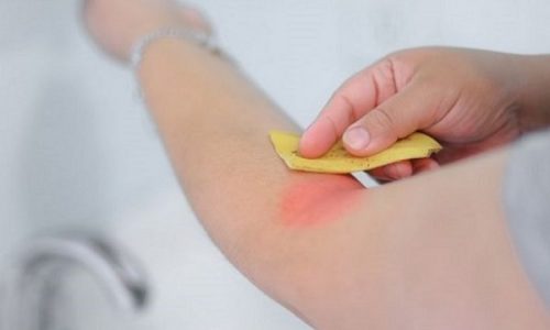 Bananskall på insektstikk