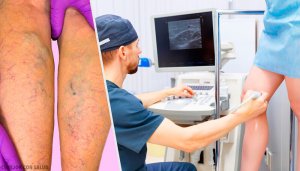 Naturlige topiske og orale behandlinger for åreknuter