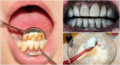 3 effektive hjemmebehandlinger for å fjerne tannstein fra tennene dine