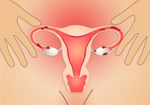 Endometriose og anatomi