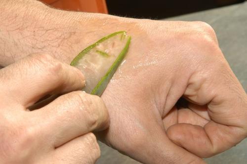 Aloe vera på solbrenthet