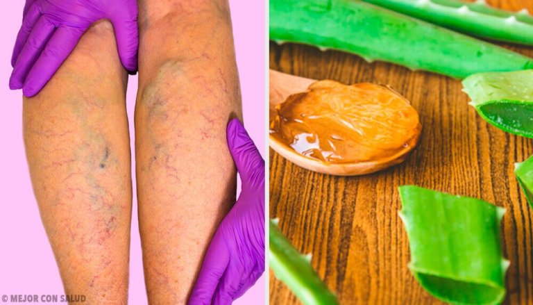 Kurer åreknuter med denne aloe vera-behandlingen